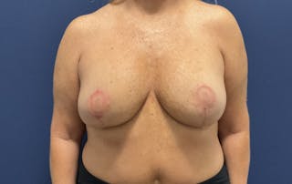Breast Lift with Implant Exchange Dr. Booth Before & After Gallery - Patient 387091 - Image 2