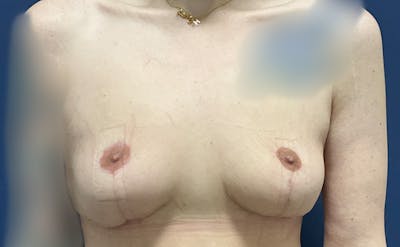 Breast Lift by Dr. Booth Before & After Gallery - Patient 241733 - Image 2