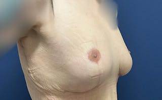 Breast Lift by Dr. Booth Before & After Gallery - Patient 241733 - Image 4