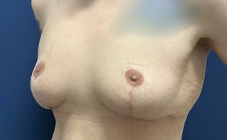 Breast Lift by Dr. Booth Before & After Gallery - Patient 241733 - Image 6