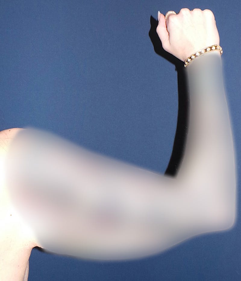 Brachioplasty by Dr. Booth Before & After Gallery - Patient 460179 - Image 1