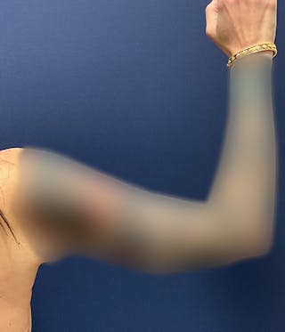 Brachioplasty by Dr. Booth Before & After Gallery - Patient 460179 - Image 2
