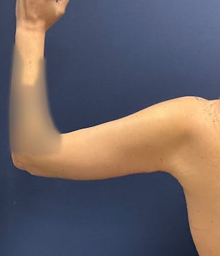 Brachioplasty by Dr. Booth Before & After Gallery - Patient 460179 - Image 4