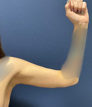 Brachioplasty by Dr. Booth Before & After Gallery - Patient 460179 - Image 6