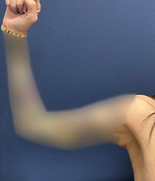 Brachioplasty by Dr. Booth Before & After Gallery - Patient 460179 - Image 8