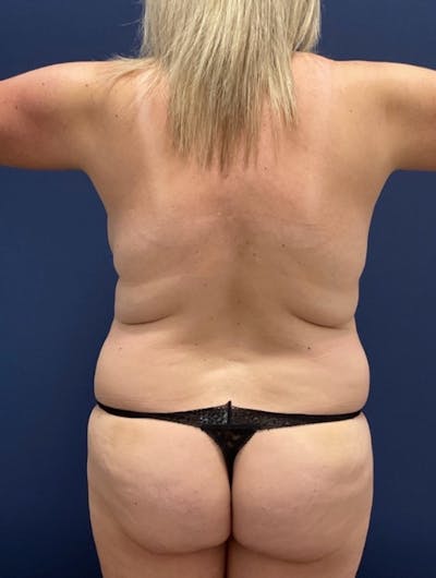 Tummy Tuck by Dr. Haydon Before & After Gallery - Patient 116319 - Image 1