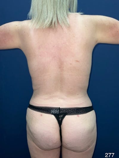 Tummy Tuck by Dr. Haydon Before & After Gallery - Patient 116319 - Image 2