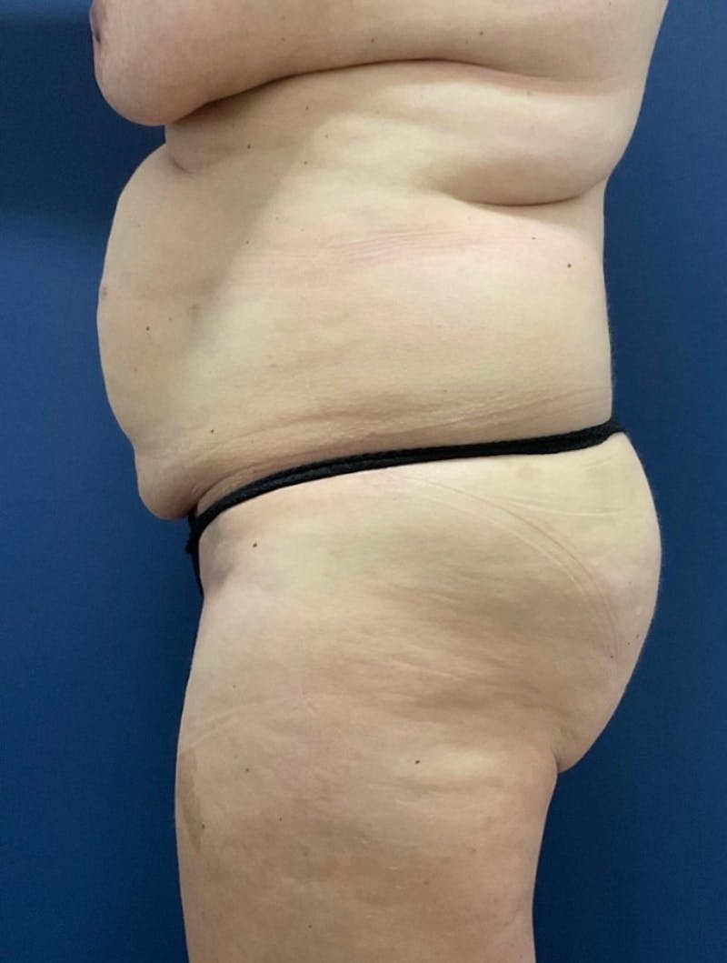 Tummy Tuck by Dr. Haydon Before & After Gallery - Patient 116319 - Image 3