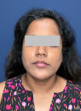 MyEllevate by Dr. Haydon Before & After Gallery - Patient 581610 - Image 2