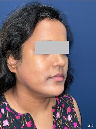 MyEllevate by Dr. Haydon Before & After Gallery - Patient 581610 - Image 4