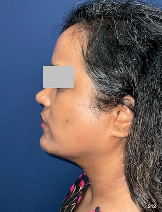 MyEllevate by Dr. Haydon Before & After Gallery - Patient 581610 - Image 10