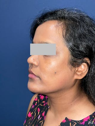 MyEllevate by Dr. Haydon Before & After Gallery - Patient 581610 - Image 8