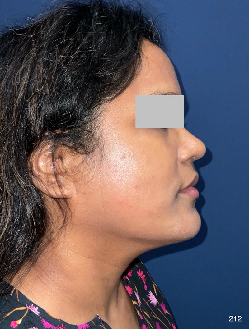 MyEllevate by Dr. Haydon Before & After Gallery - Patient 581610 - Image 6