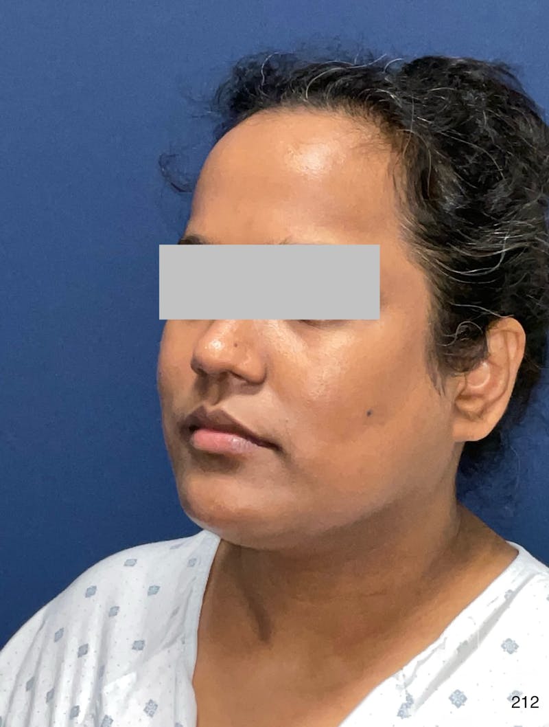 MyEllevate by Dr. Haydon Before & After Gallery - Patient 581610 - Image 7