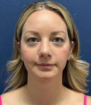 MyEllevate by Dr. Booth Before & After Gallery - Patient 106750 - Image 2