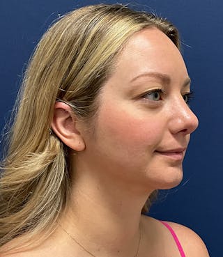 MyEllevate by Dr. Booth Before & After Gallery - Patient 106750 - Image 4