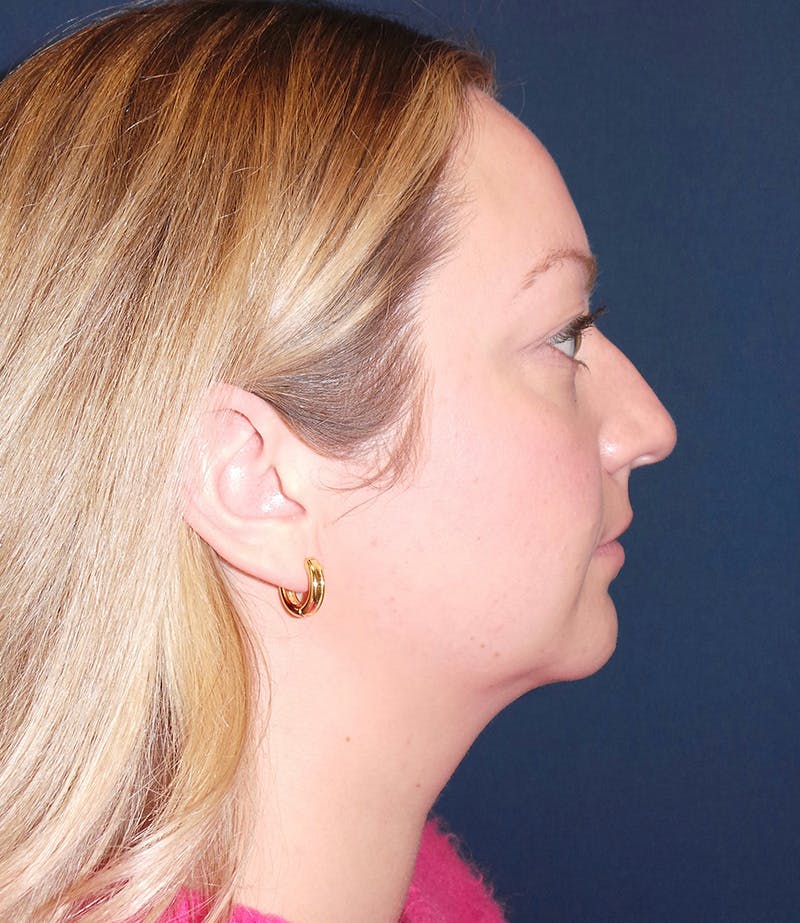 MyEllevate by Dr. Booth Before & After Gallery - Patient 106750 - Image 5