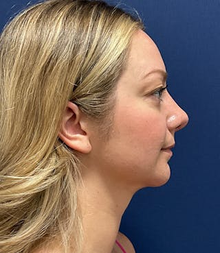 MyEllevate by Dr. Booth Before & After Gallery - Patient 106750 - Image 6