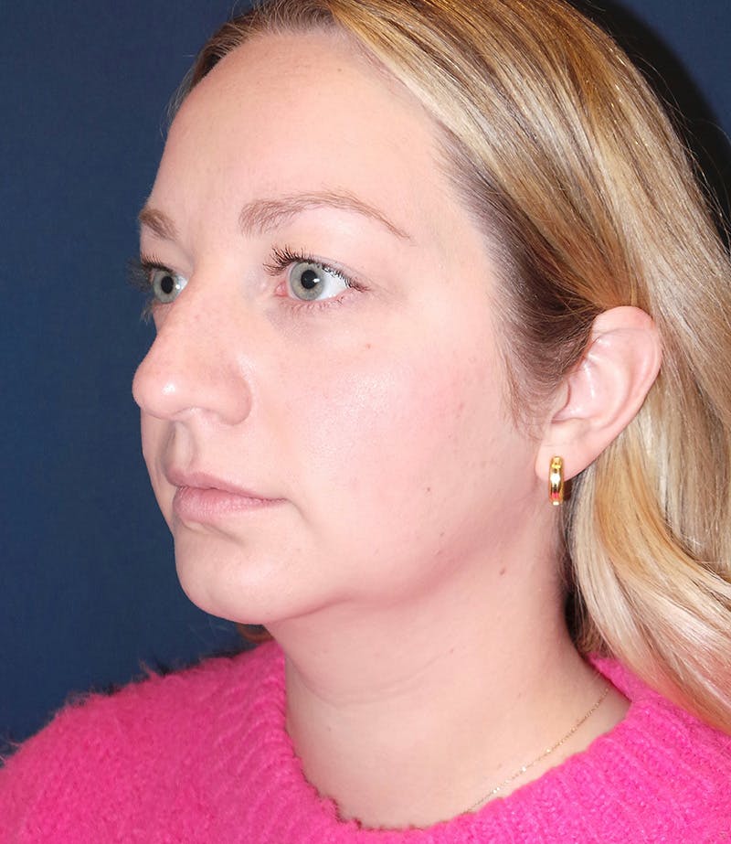 MyEllevate by Dr. Booth Before & After Gallery - Patient 106750 - Image 7