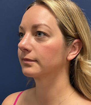 MyEllevate by Dr. Booth Before & After Gallery - Patient 106750 - Image 8