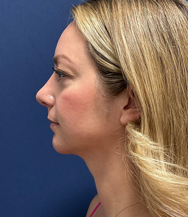 MyEllevate by Dr. Booth Before & After Gallery - Patient 106750 - Image 10