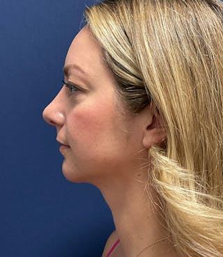 MyEllevate by Dr. Booth Before & After Gallery - Patient 106750 - Image 10