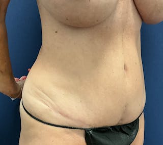 Tummy Tuck by Dr. Booth Before & After Gallery - Patient 168498 - Image 4
