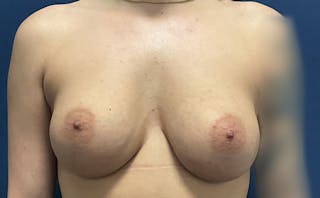 Breast Augmentation by Dr. Booth Before & After Gallery - Patient 144795 - Image 2