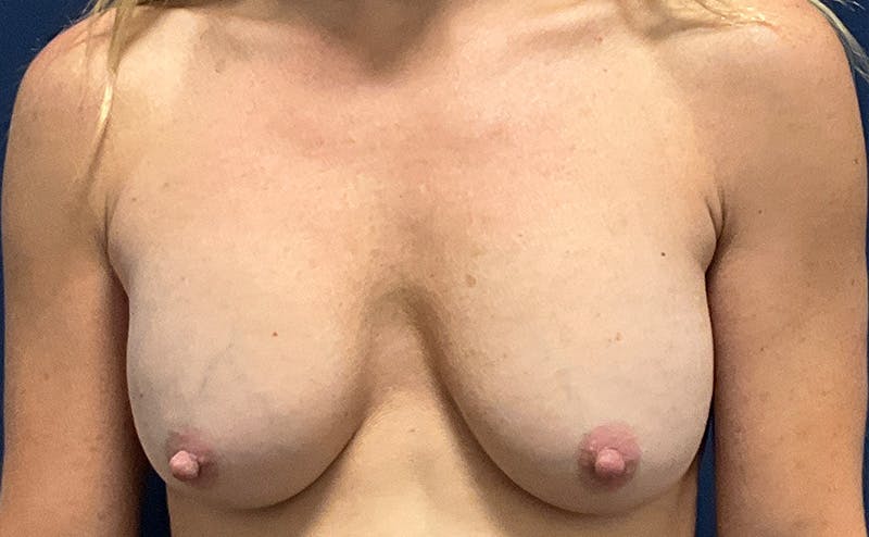 Implant Exchange by Dr. Booth Before & After Gallery - Patient 124951 - Image 1
