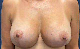 Breast Lift with Augmentation Dr. Booth Before & After Gallery - Patient 405447 - Image 2