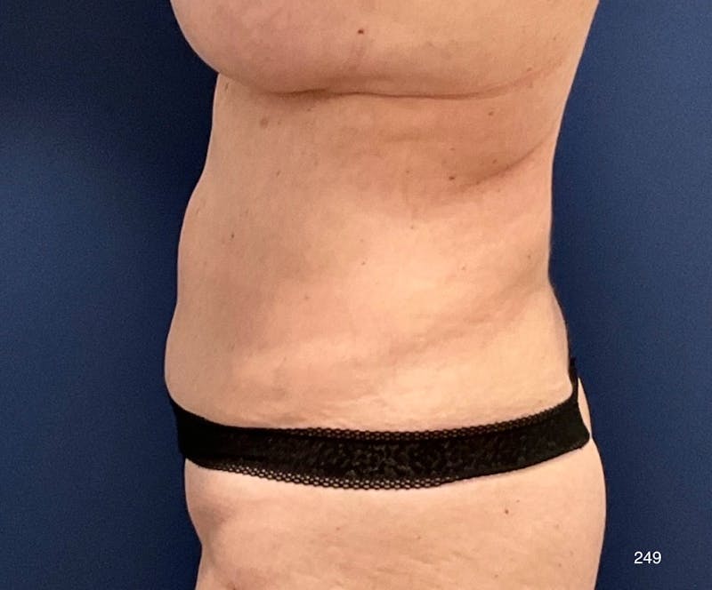 BodyTite/MorpheusBody by Dr. Haydon Before & After Gallery - Patient 382155 - Image 3
