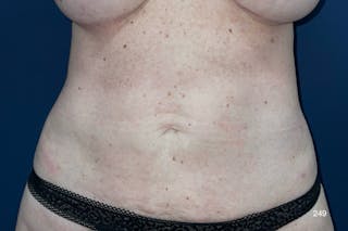 BodyTite/MorpheusBody by Dr. Haydon Before & After Gallery - Patient 382155 - Image 2