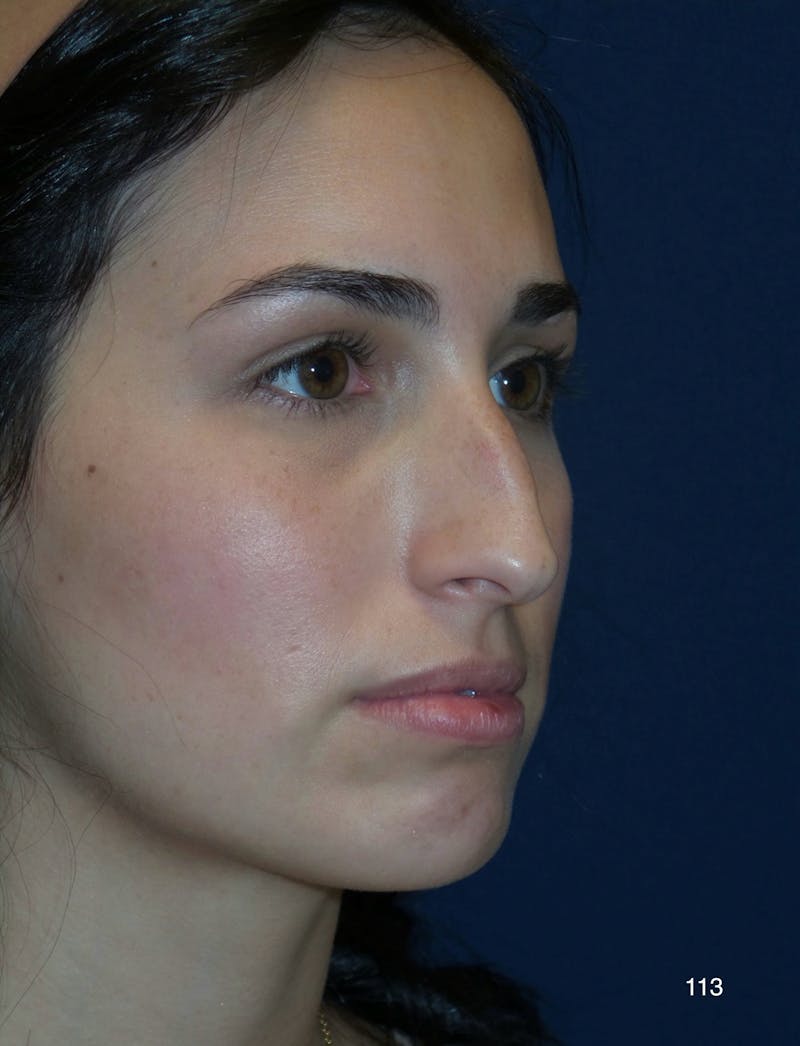 Rhinoplasty by Dr. Haydon Before & After Gallery - Patient 398341 - Image 1