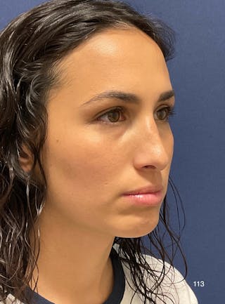 Rhinoplasty by Dr. Haydon Before & After Gallery - Patient 398341 - Image 2