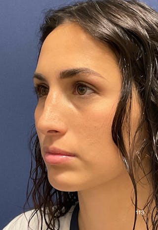 Rhinoplasty by Dr. Haydon Before & After Gallery - Patient 398341 - Image 4