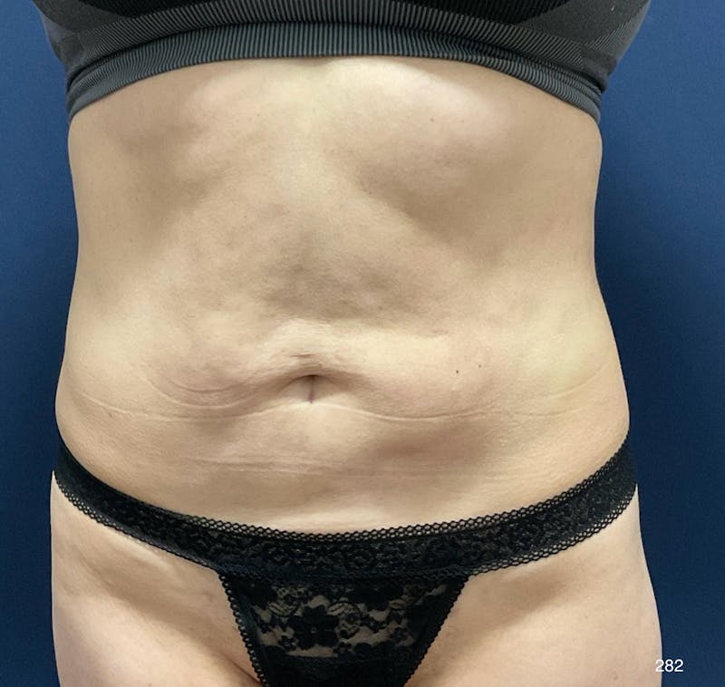 Tummy Tuck by Dr. Haydon Before & After Gallery - Patient 179347 - Image 1