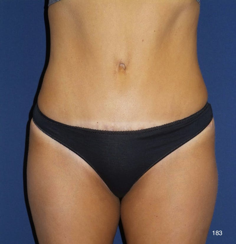 Tummy Tuck by Dr. Haydon Before & After Gallery - Patient 106050 - Image 1