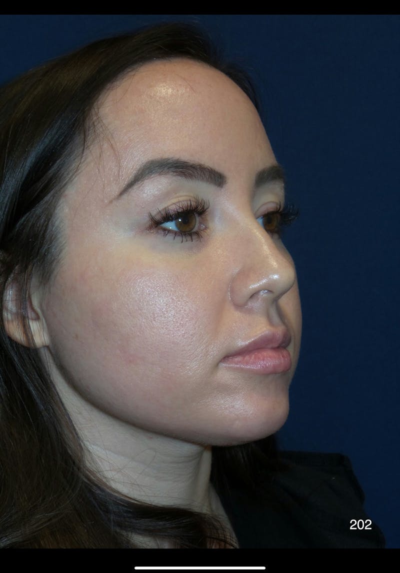 Submental Liposuction by Dr. Haydon Before & After Gallery - Patient 320360 - Image 1
