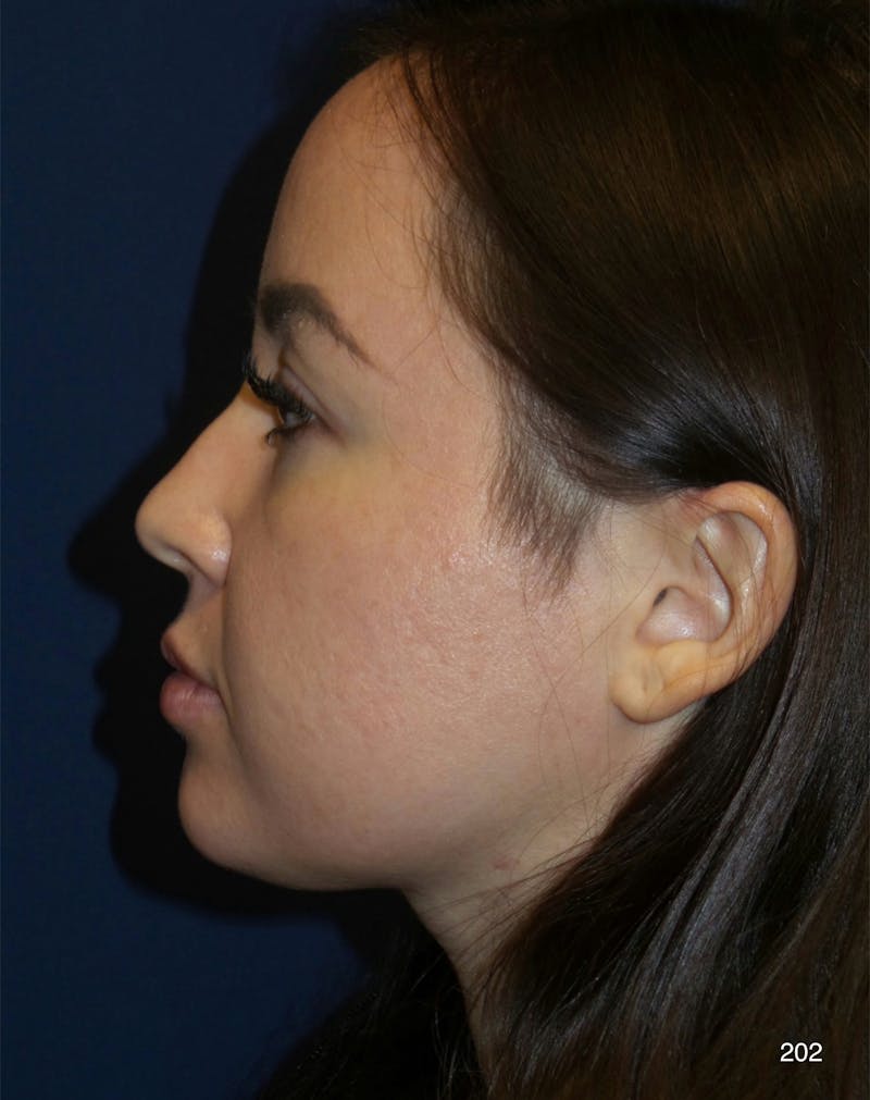 Submental Liposuction by Dr. Haydon Before & After Gallery - Patient 320360 - Image 5