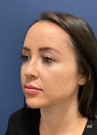 Buccal Fat Pad Removal by Dr. Haydon Before & After Gallery - Patient 367092 - Image 4