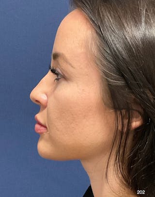 Buccal Fat Pad Removal by Dr. Haydon Before & After Gallery - Patient 367092 - Image 6