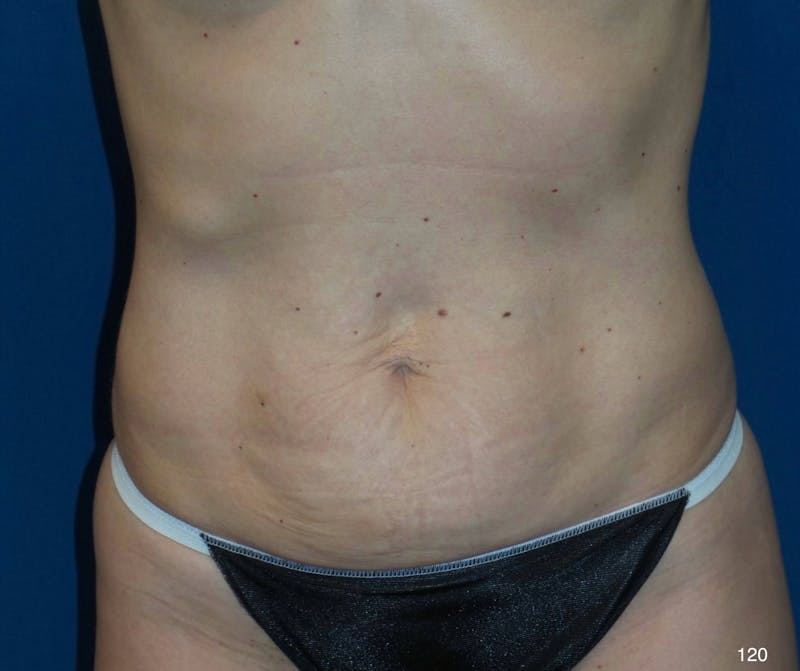 Tummy Tuck by Dr. Haydon Before & After Gallery - Patient 519389 - Image 1