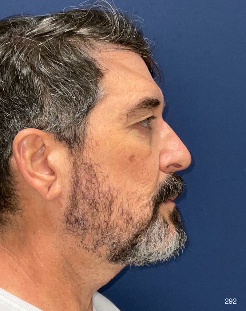 Neck Lift by Dr. Haydon Before & After Gallery - Patient 174555 - Image 4