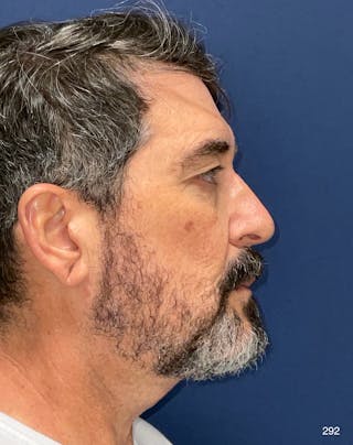 Neck Lift by Dr. Haydon Before & After Gallery - Patient 174555 - Image 4