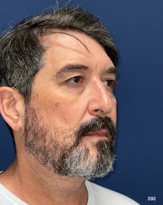 Neck Lift by Dr. Haydon Before & After Gallery - Patient 174555 - Image 2