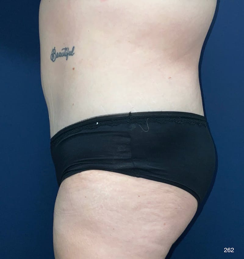 Tummy Tuck by Dr. Haydon Before & After Gallery - Patient 231891 - Image 4