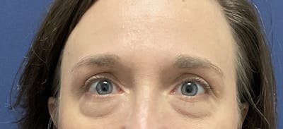 Eyelid Surgery by Dr. Haydon Before & After Gallery - Patient 193090 - Image 2