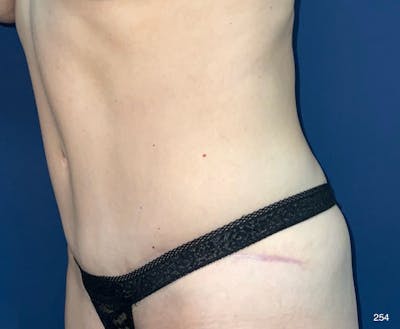 Tummy Tuck by Dr. Haydon Before & After Gallery - Patient 148752 - Image 2