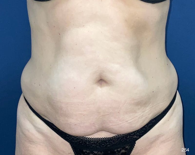 Tummy Tuck by Dr. Haydon Before & After Gallery - Patient 148752 - Image 1