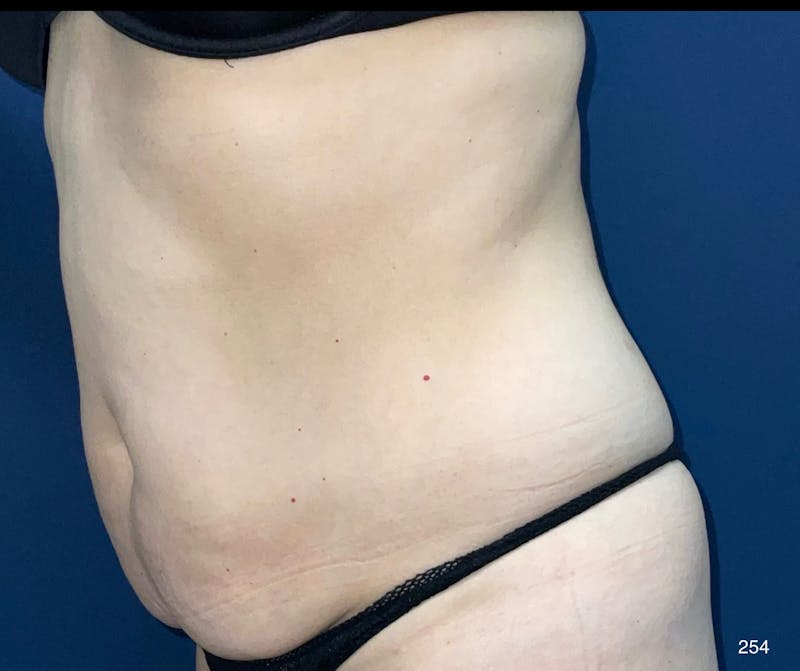 Tummy Tuck by Dr. Haydon Before & After Gallery - Patient 148752 - Image 3